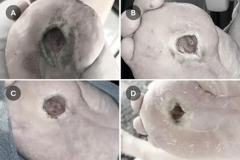 Debetic Wound Care