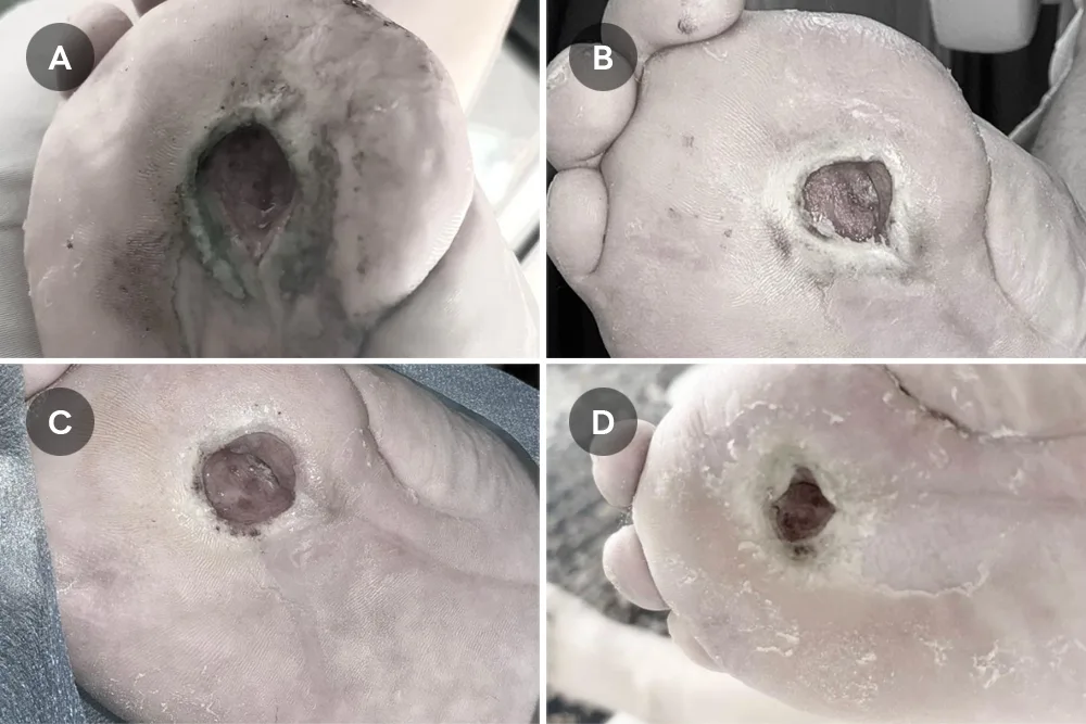 Debetic Wound Care