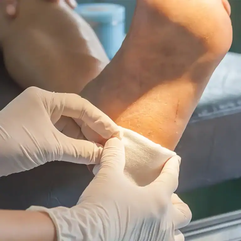 A diabetic wounds treatment done by a specialist at Vega