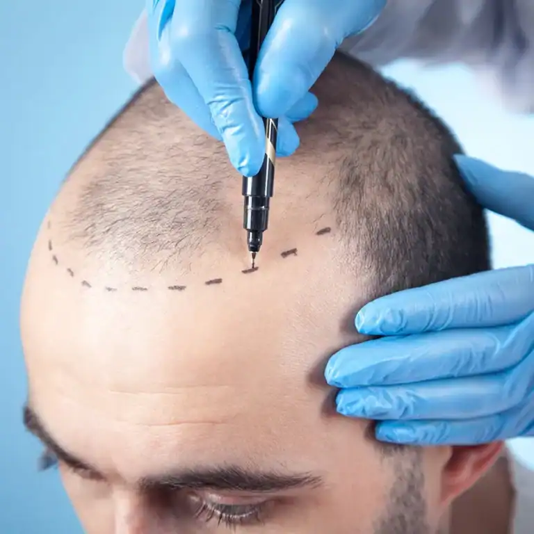 Physician administering hair regrowth treatment at Vega clinic