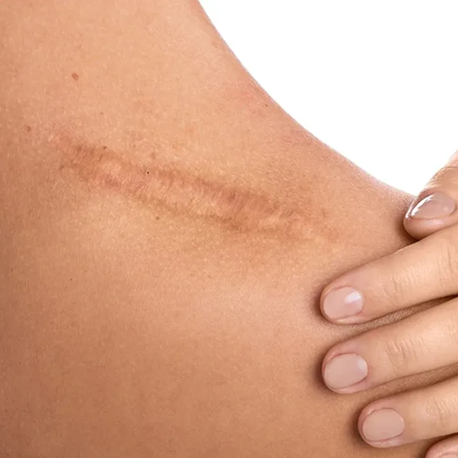 Scar & Tissue Remodeling