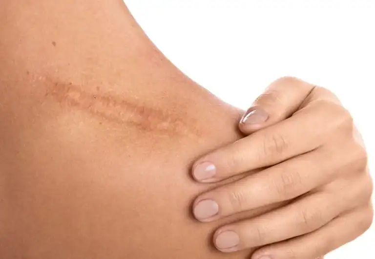 scar and tissue remodeling