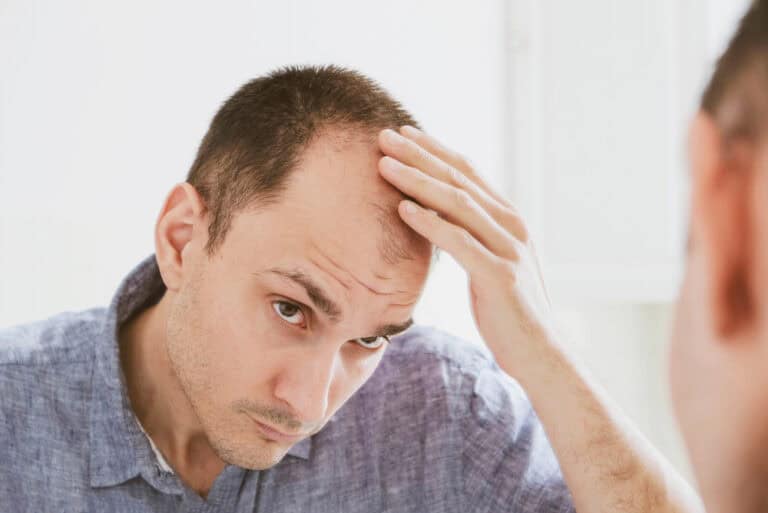 A: Worried man checking thinning hair and how hormones contribute to hair loss issues