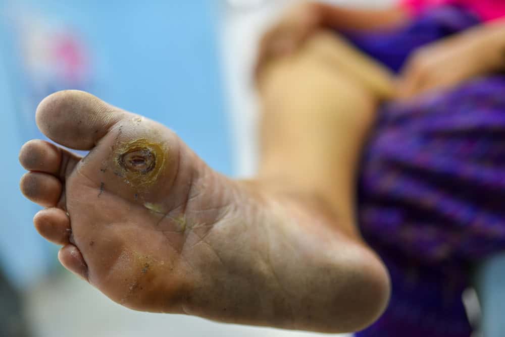 Diabetic foot ulcer on the sole, showing how diabetic wounds differ in elderly patients