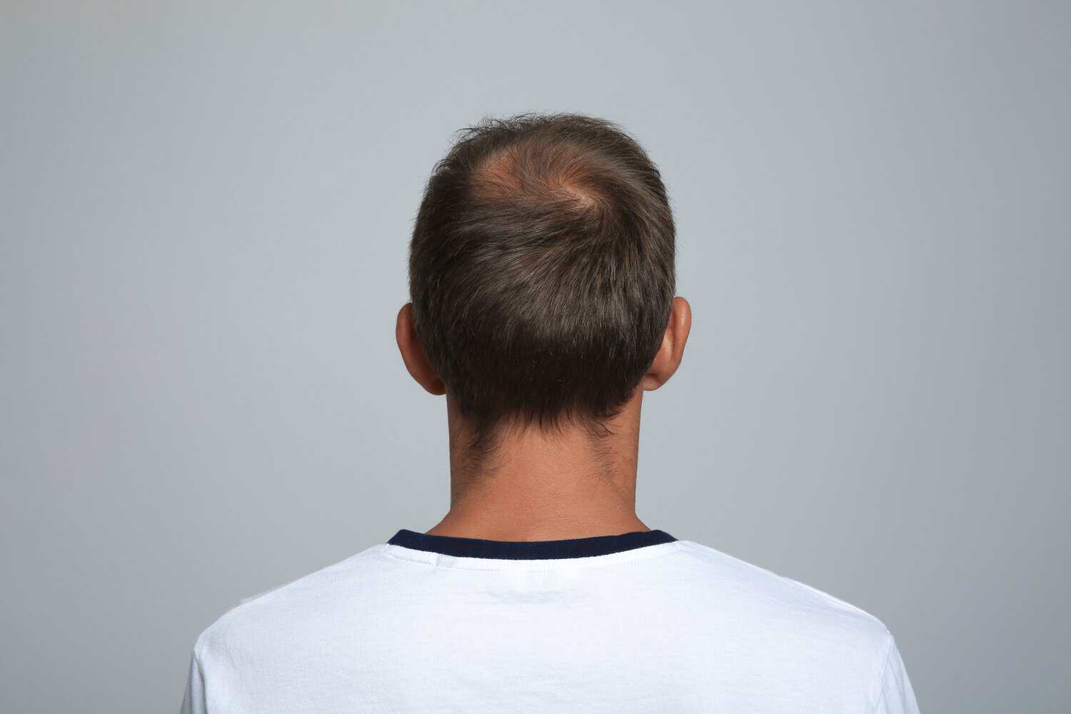 Man with crown hair loss looking at hair transplant techniques