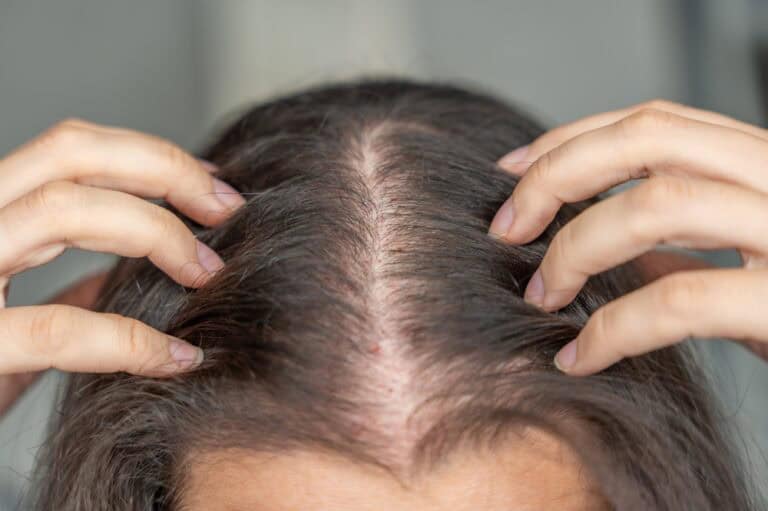 Visible thinning at the part may be one of the environmental causes of hair loss