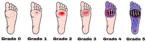 Wagner Classification Grades for Diabetic Foot Ulcers