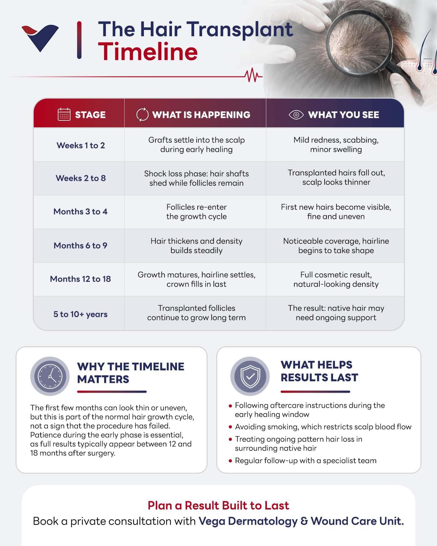 Infographic timeline showing what a hair transplant looks like years later