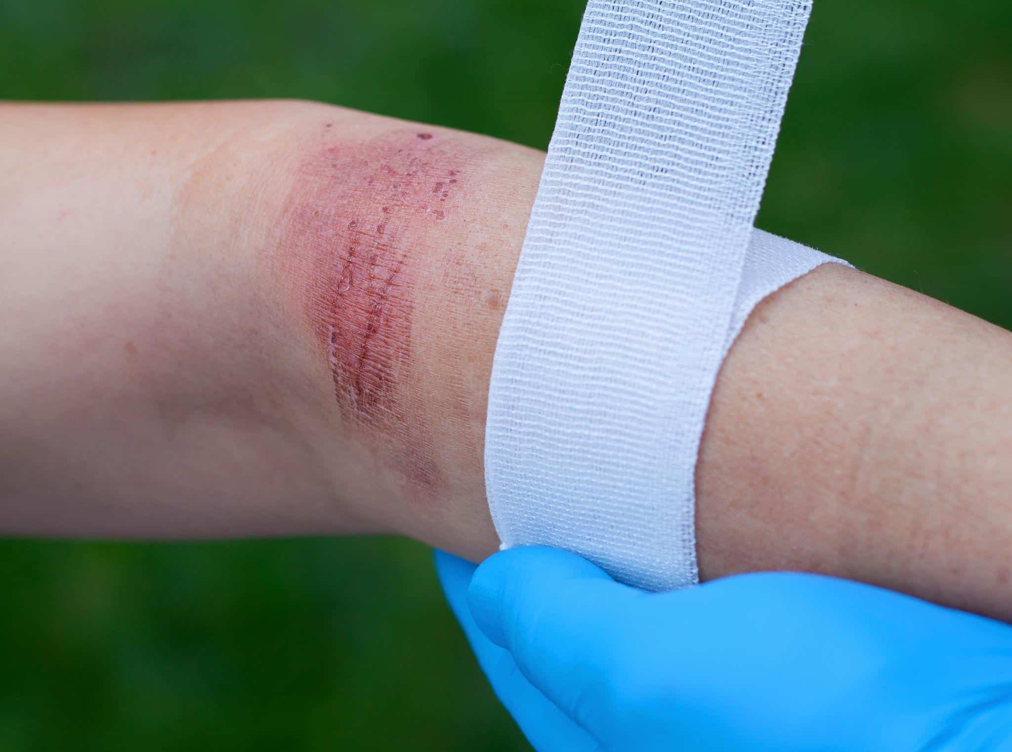 A patient getting treatment for burn scars on their arm