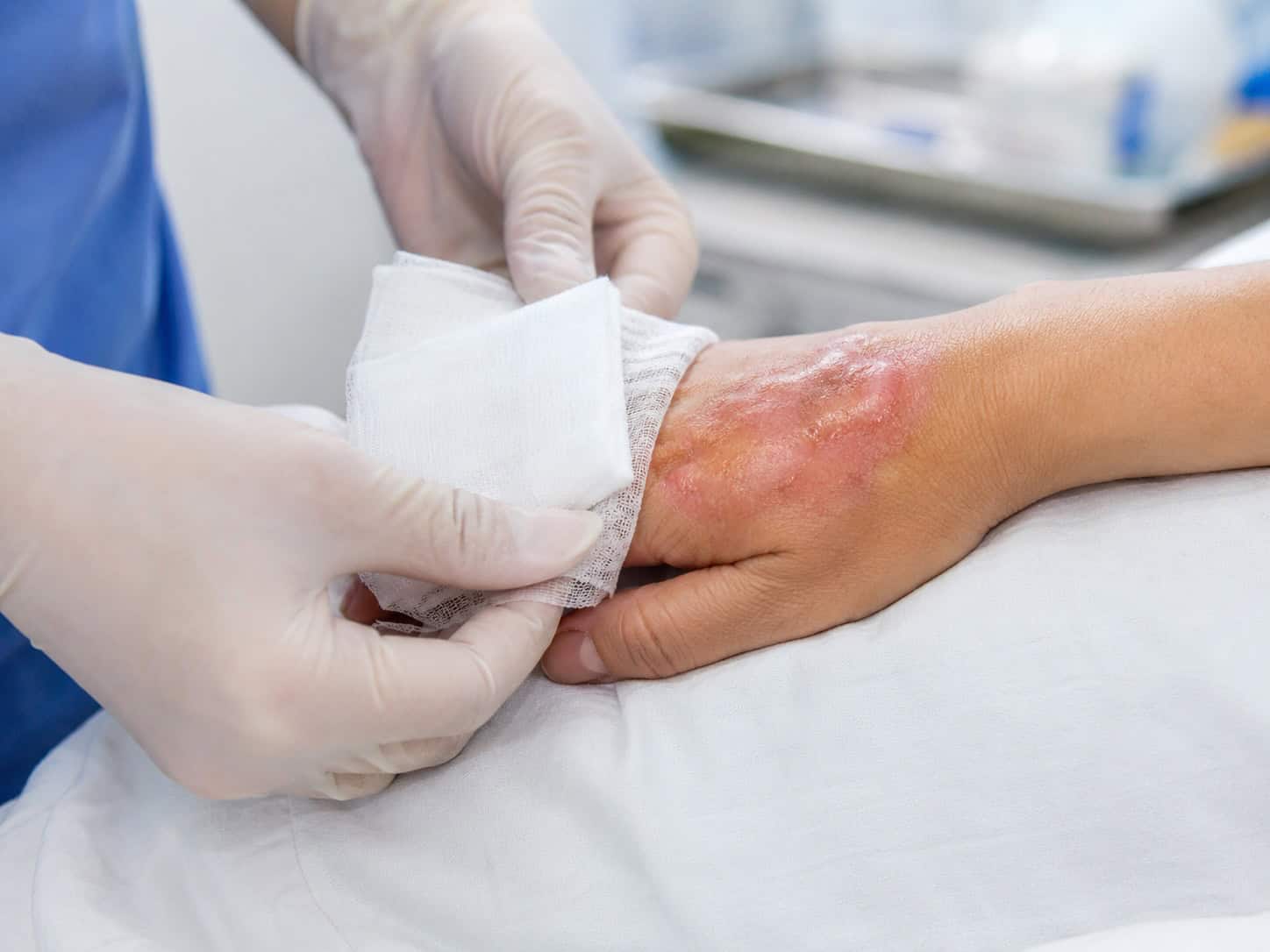A patient getting dressing for burn wound headling on their hand 