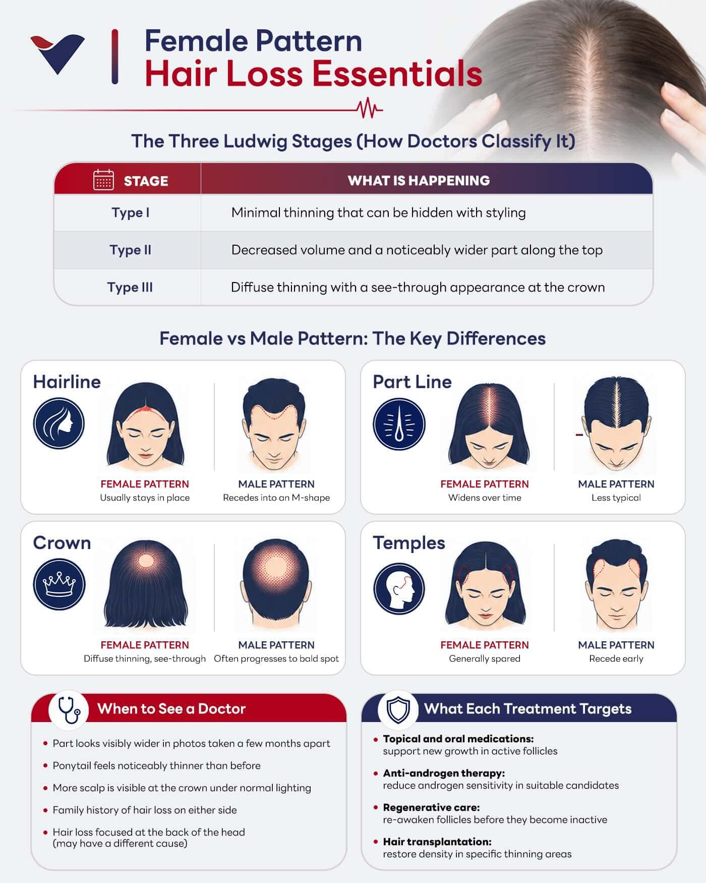 Infographic explaining the stages, patterns, and treatment options for female pattern hair loss