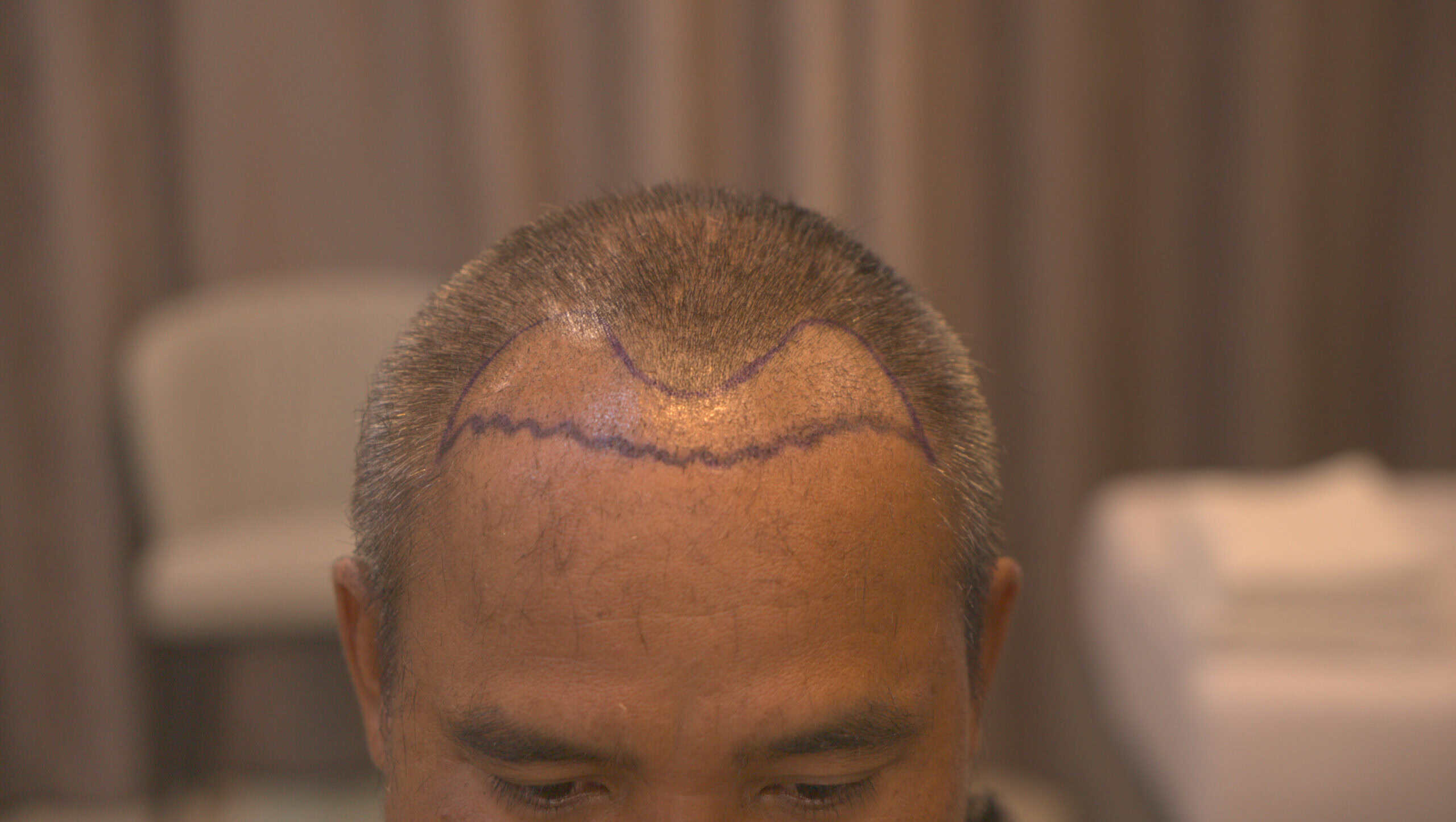 A patient’s marked scalp for a hair restoration treatment