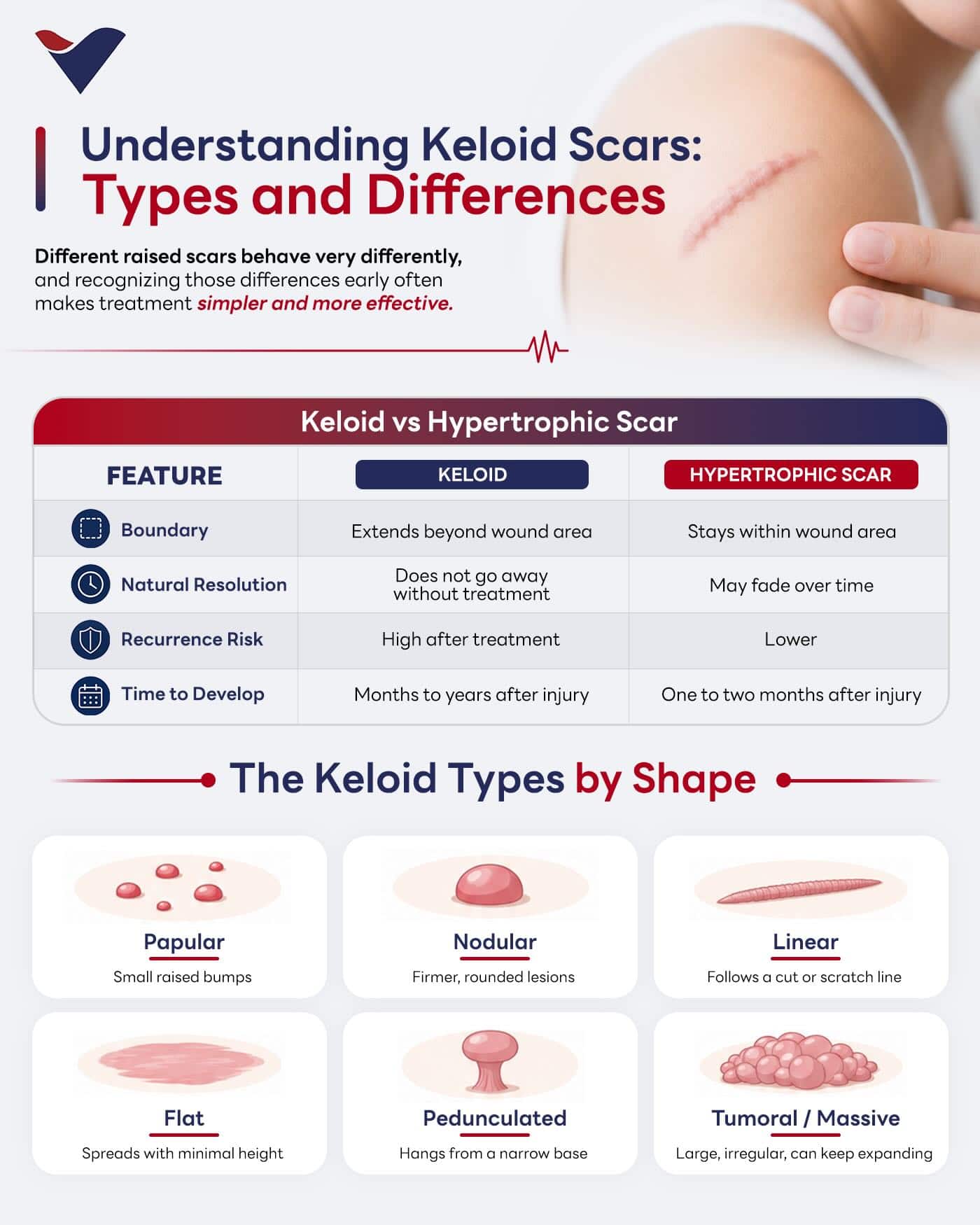 Visual guide to the types of keloid scars and how they differ from other raised scars