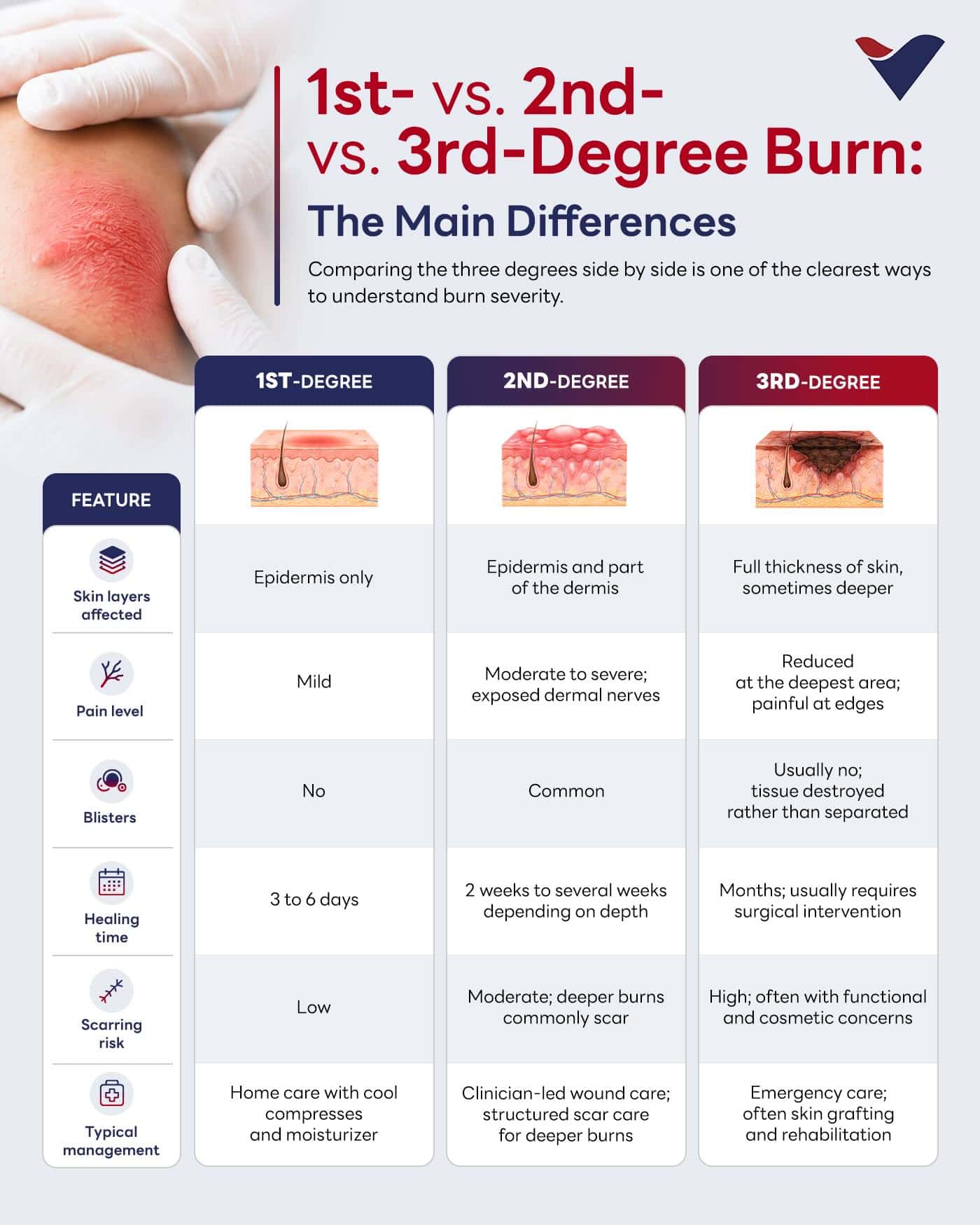 1st vs. 2nd vs. 3rd-Degree Burns.