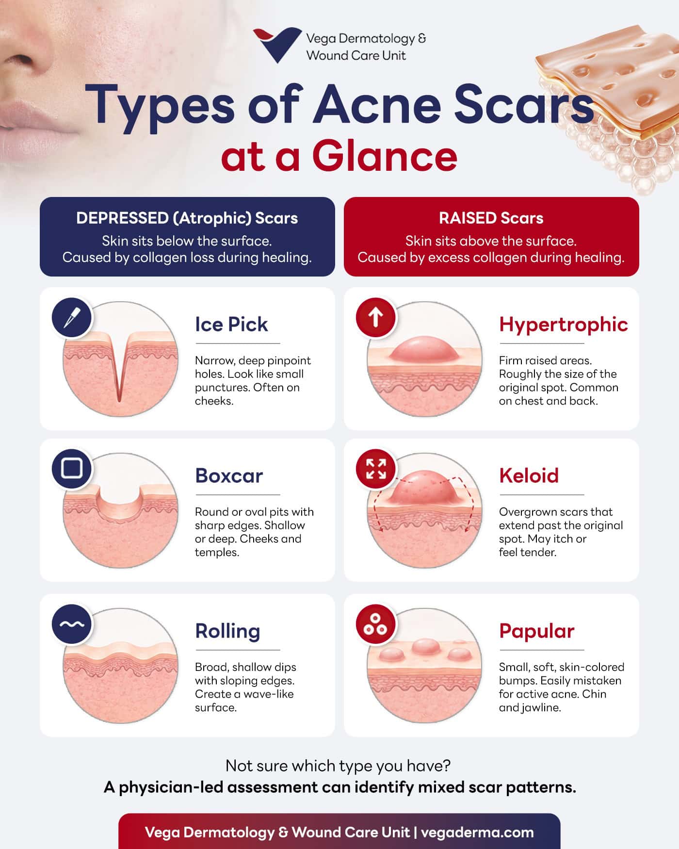 Infographic comparing the main types of acne scars including ice pick, boxcar, and rolling.