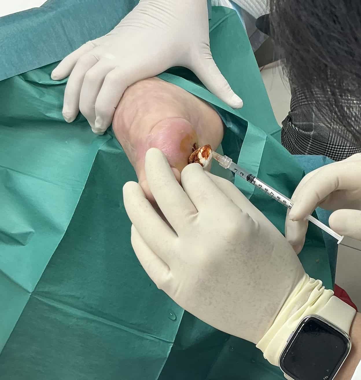 A doctor inserting an injection into a foot for diabetic foot ulcer treatment
