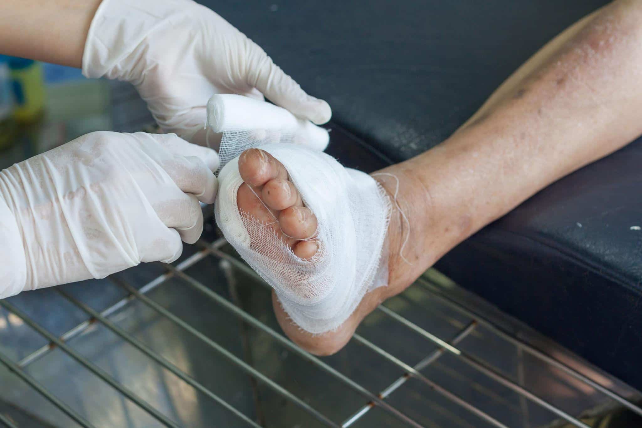 A patient getting diabetic foot wound treatment