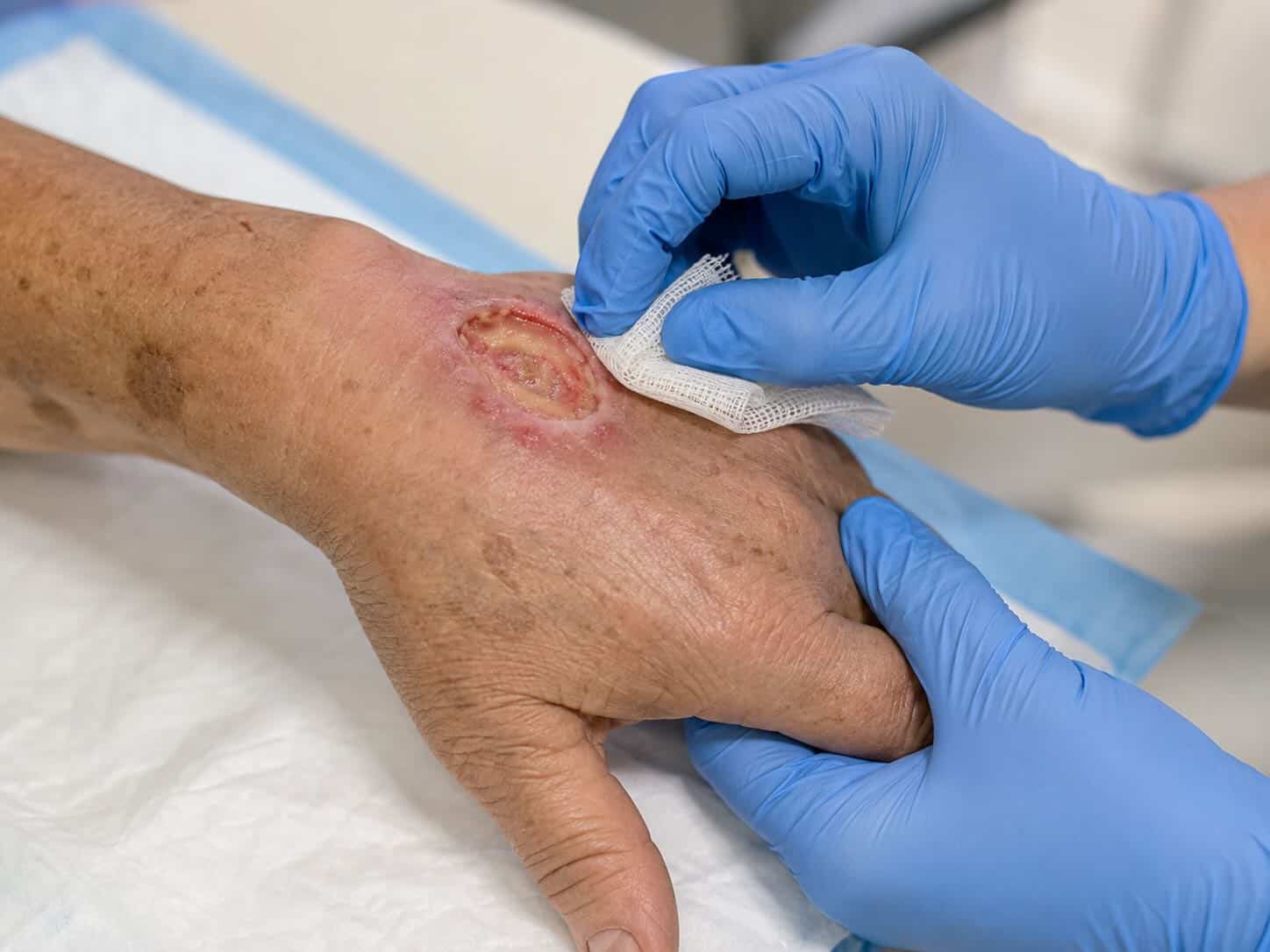 A doctor implementing chronic wound treatment on an elderly patient’s hand