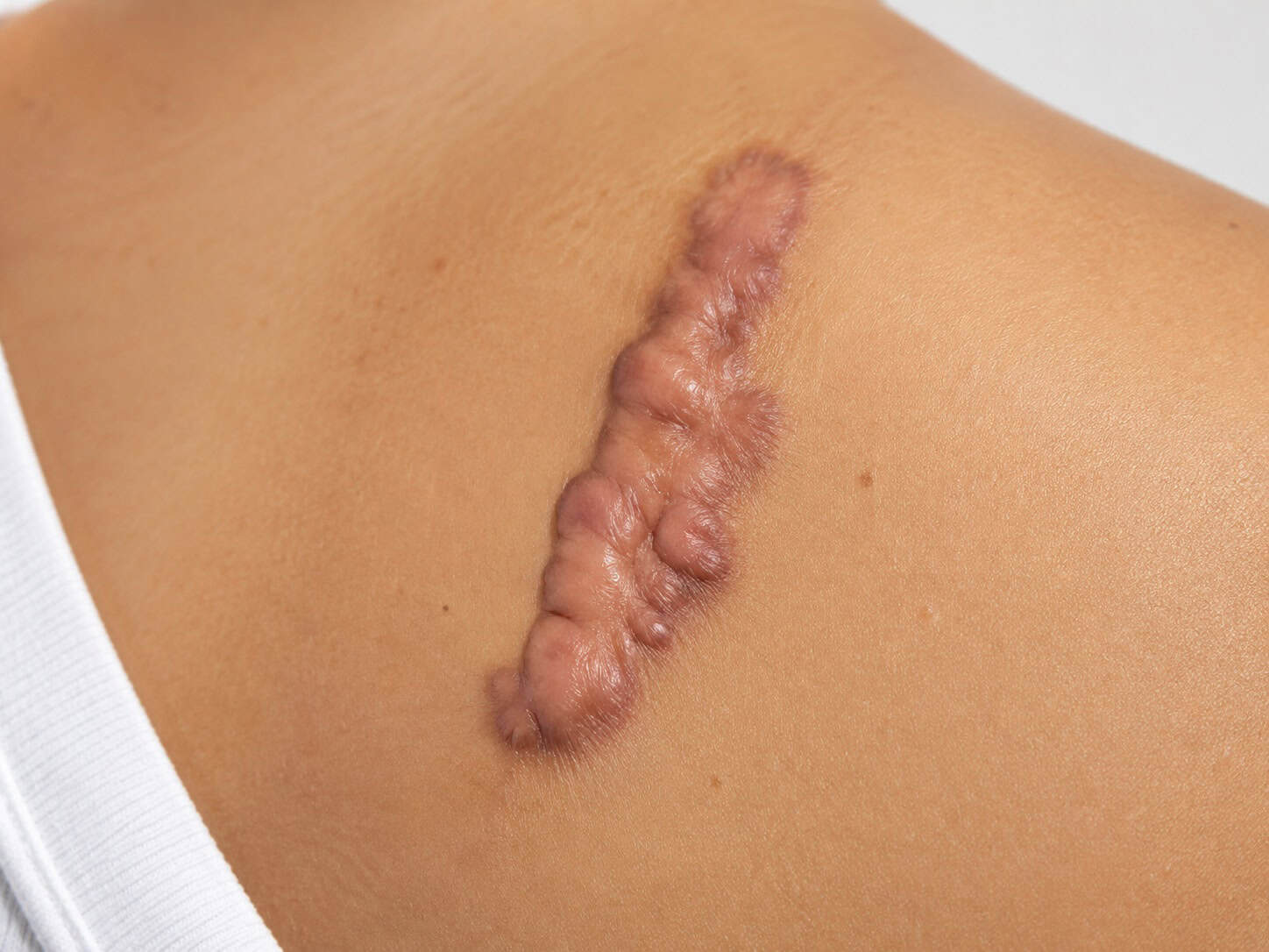 A keloid on a patient’s back from an accident