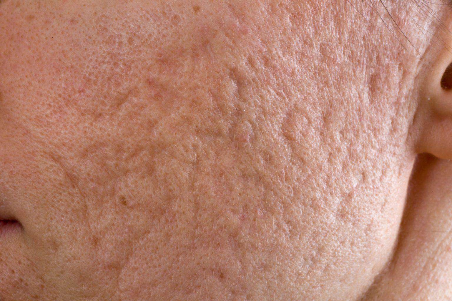 A patient’s face with acne scar ready for treatment