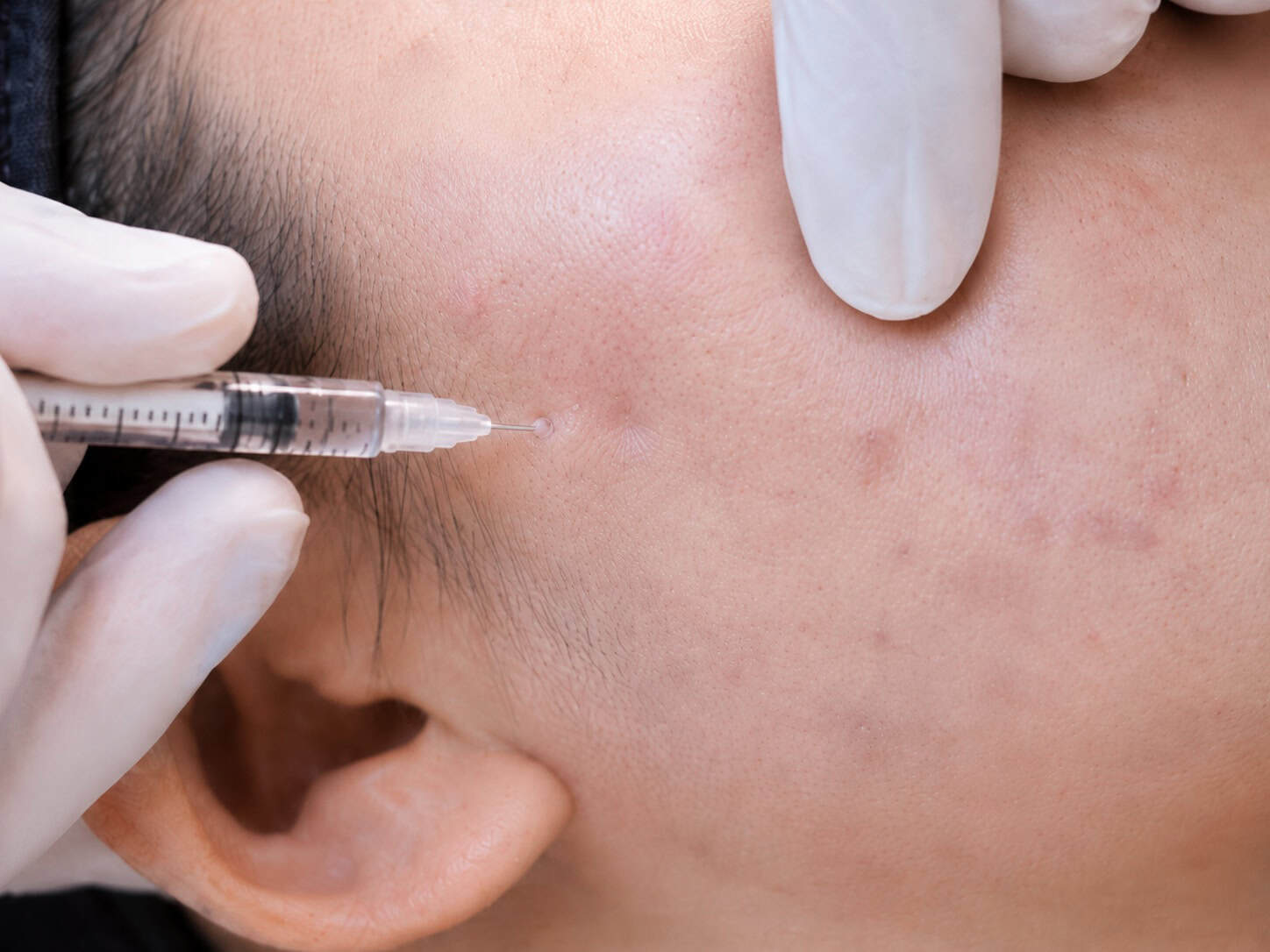 A patient getting acne scar treatment 