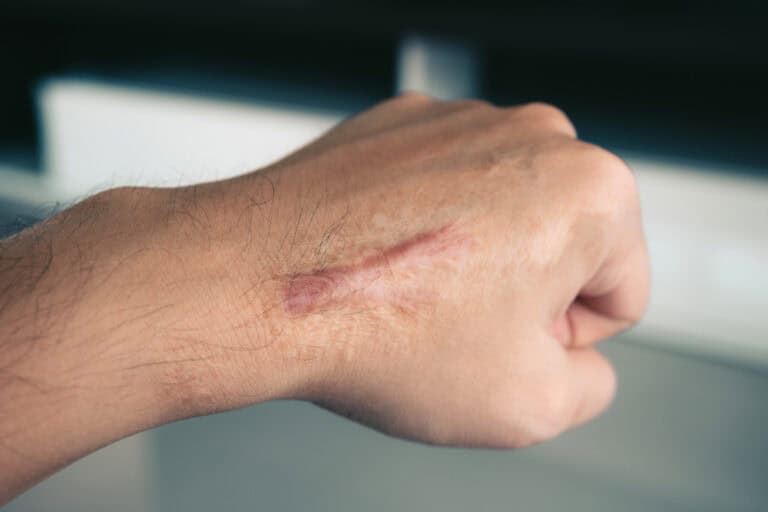 Close-up of a raised scar on the hand, an example of one of the types of keloid scars