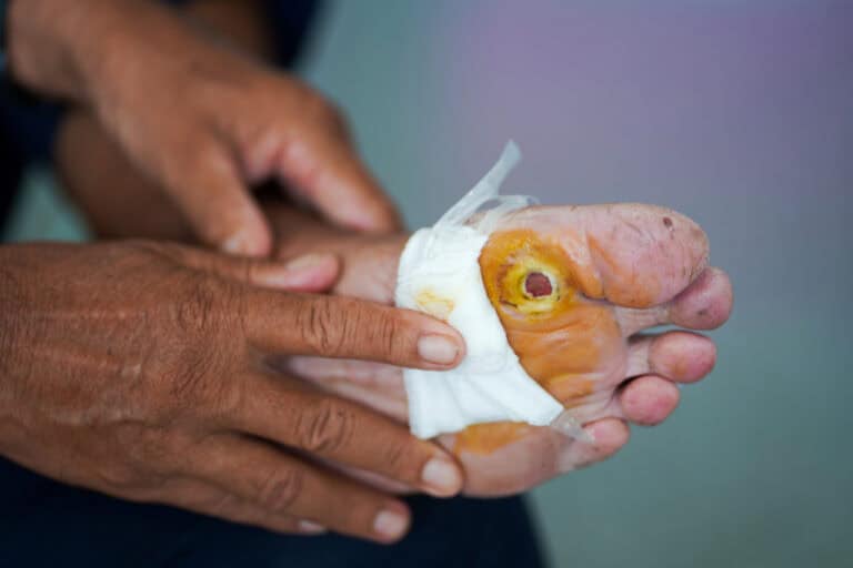 Slow healing sores on a diabetic foot receiving wound care treatment