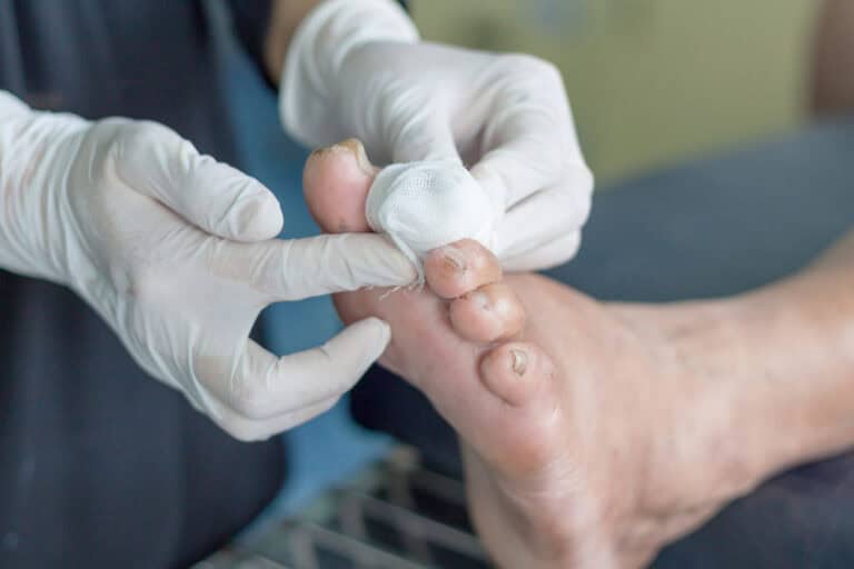 A patient getting dressing for their diabetic foot ulcer post-treatment