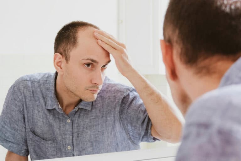 Man examining his hairline in the mirror, showing signs of androgenetic alopecia.