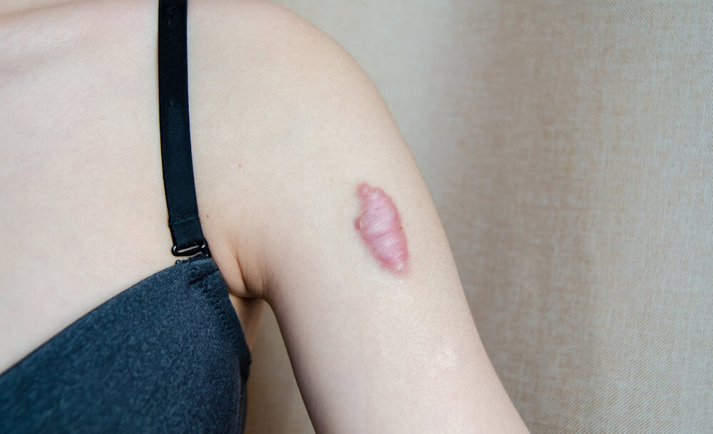 Close-up of a raised keloid scar on a woman’s arm. These scars need proper treatment for removal.