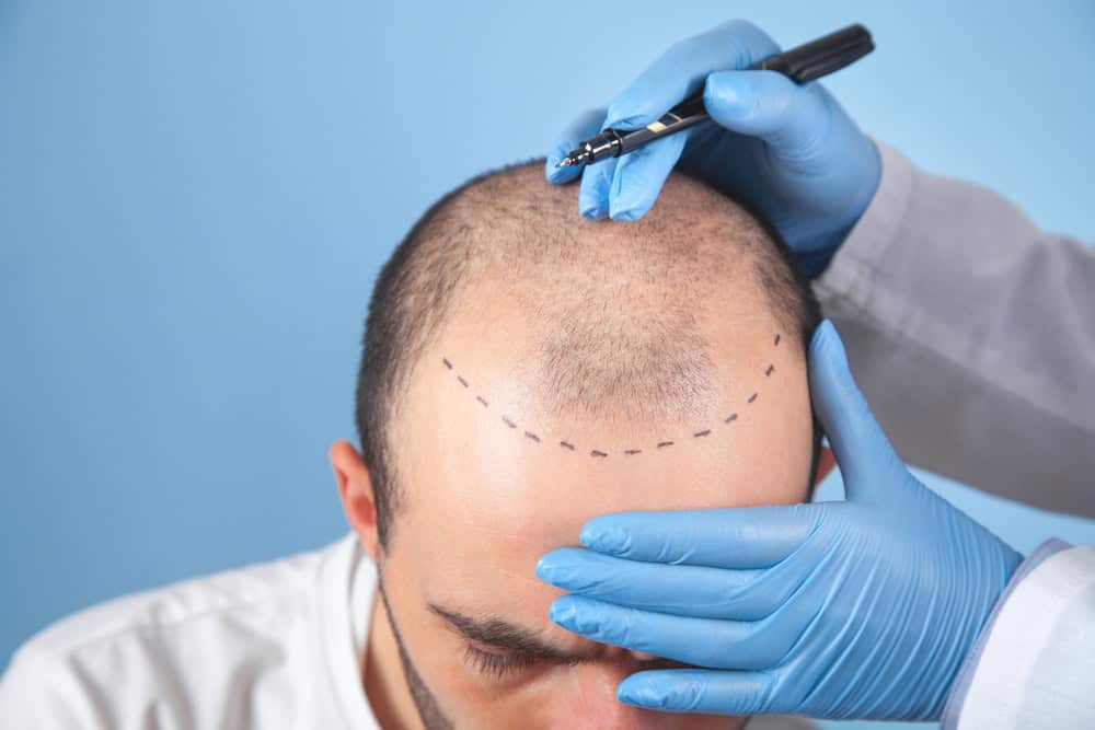 Scalp healing progress after a hair transplant.