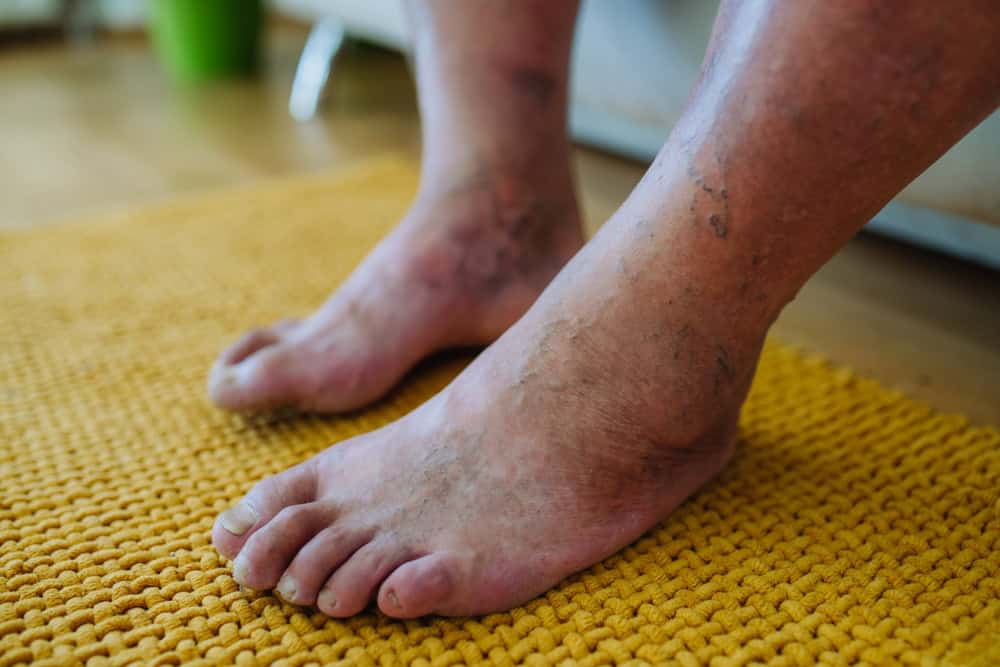 A diabetic patient with foot complications.