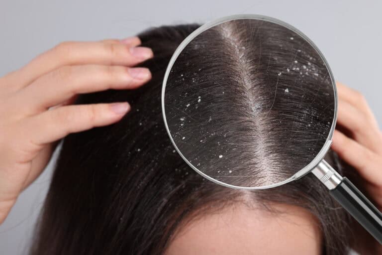 Close-up of scalp dandruff, which is irritating and may cause hair loss if left untreated