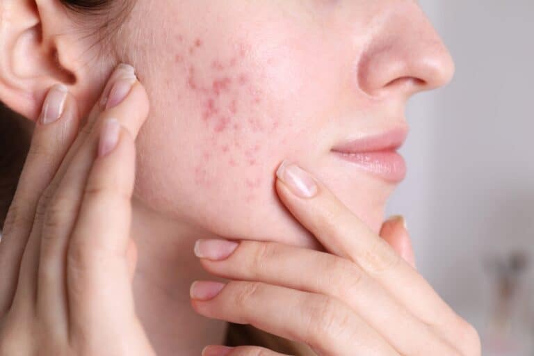 Close-up of a woman’s cheek showing ice pick acne scars, one of the types of acne scars.