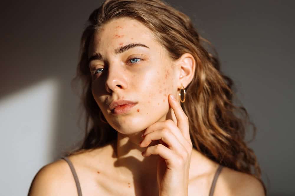 A woman with ice pick scars on her face. Ice pick, boxcar, and rolling are common acne scar types.