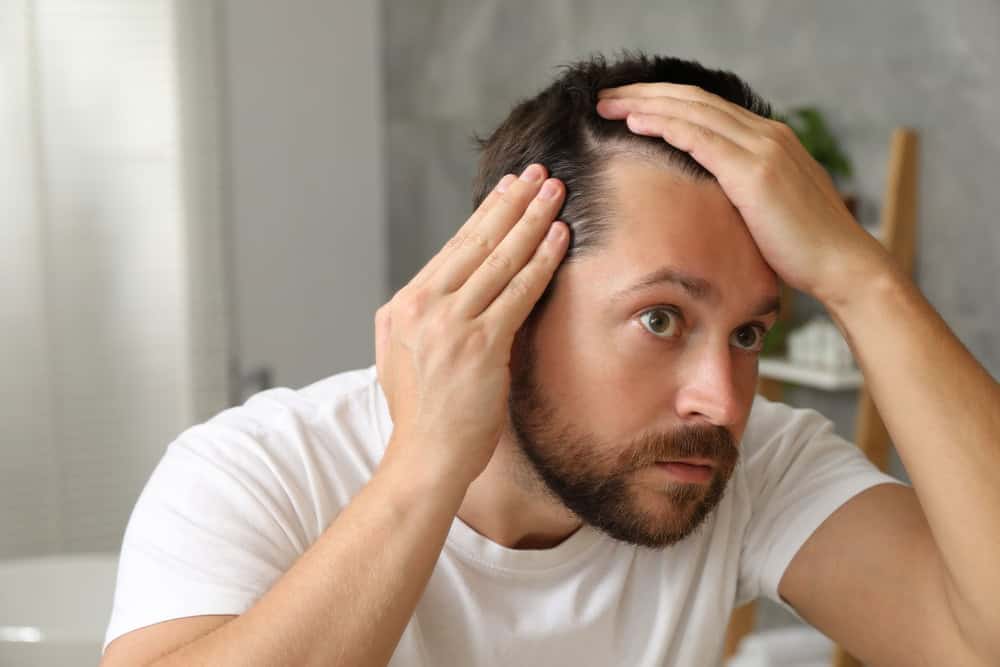 A man experiencing signs of hair loss. Creatine, despite the association, does not cause it.