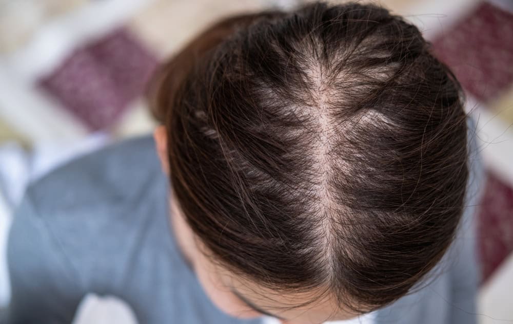 Wider mid-line part visible on a woman's scalp, an early sign of female pattern hair loss