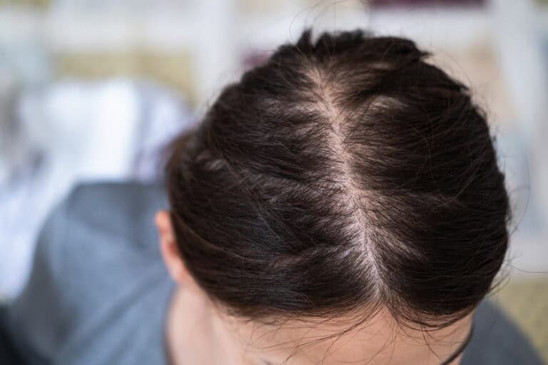 Patient with oily scalp and hair loss.