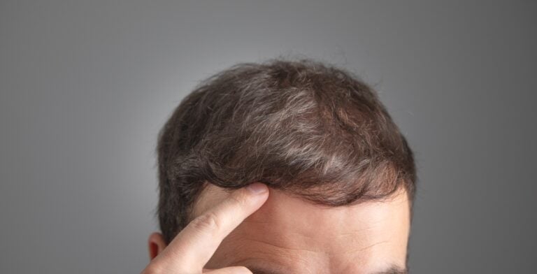 A man monitoring scalp healing progress after a hair transplant.