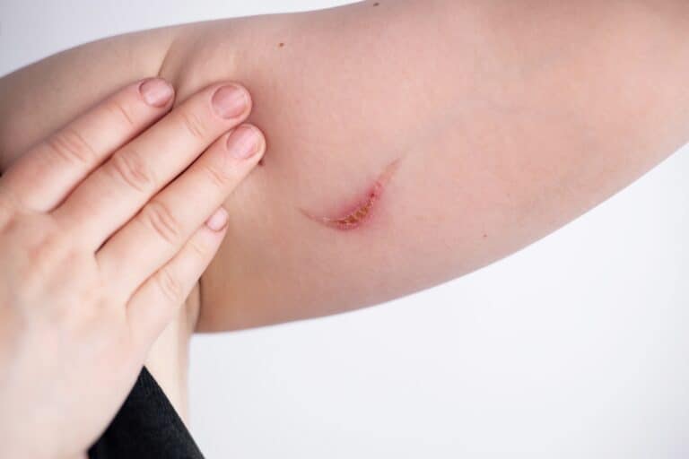 A burn on the underside of a patient’s arm.