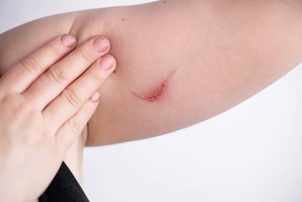 A burn on the underside of a patient’s arm.