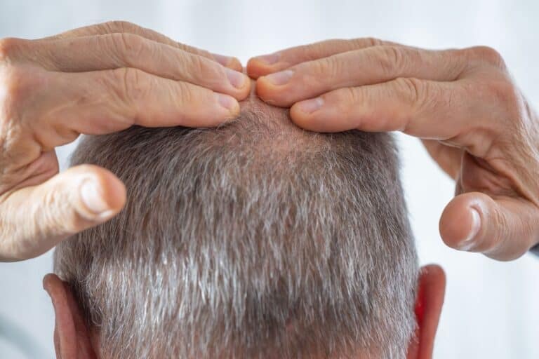 Close-up of a scalp with male pattern hair loss, a common reason patients consider minoxidil for hair loss.