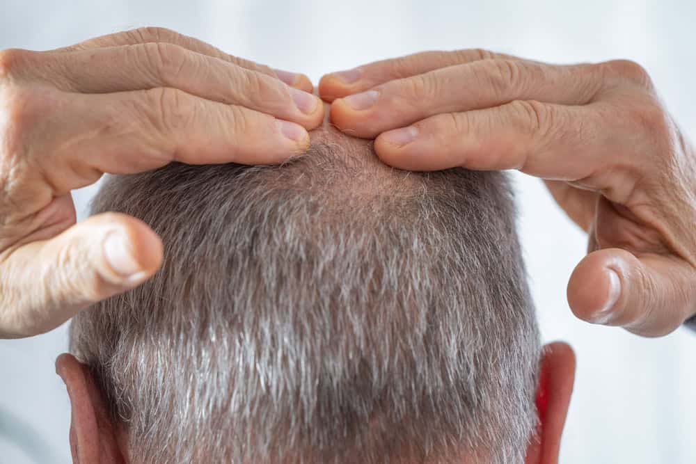 Close-up of a scalp with male pattern hair loss, a common reason patients consider minoxidil for hair loss.