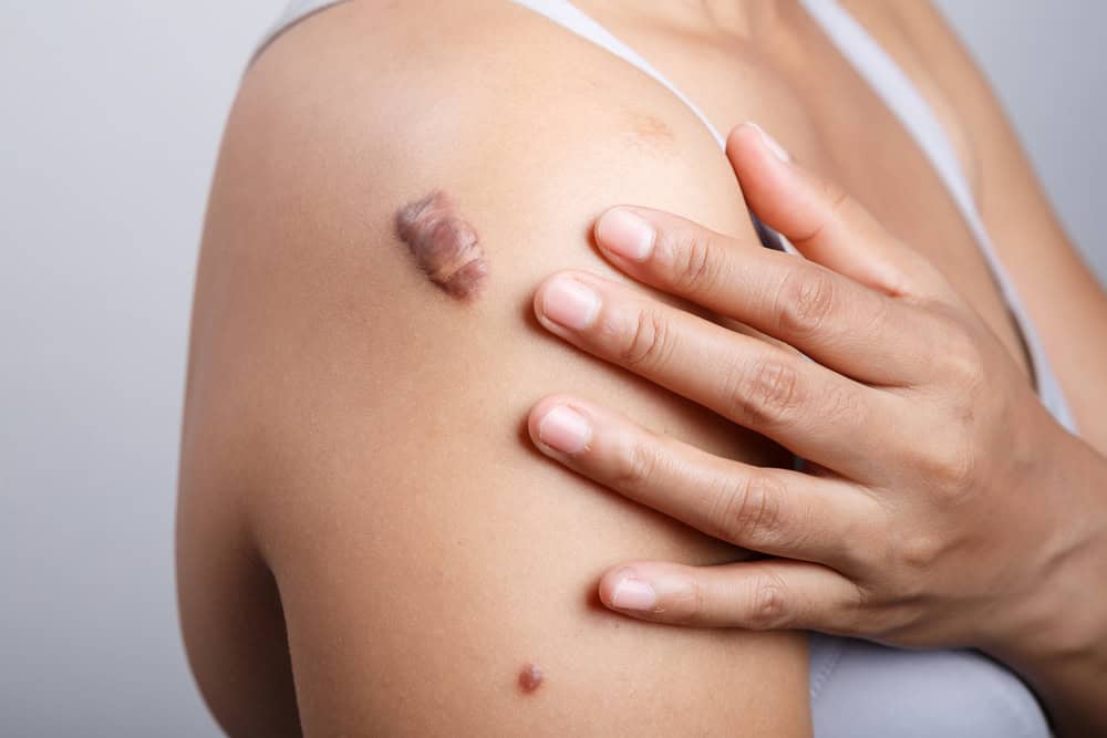Close-up of a raised keloid scar, showing the firm, shiny tissue that defines keloid scarring.