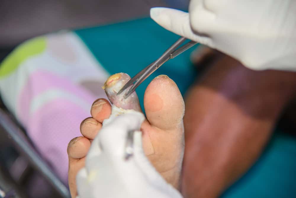 A patient with diabetic foot ulcer stage 1 getting treatment