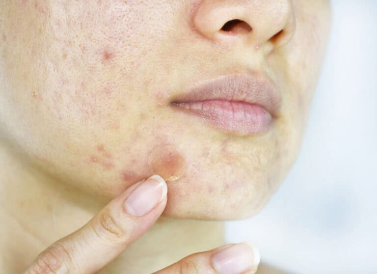 Acne scars still visible on a cheek after trying natural acne scar removal methods