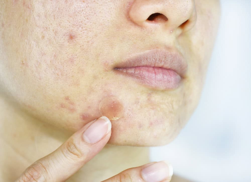 Acne scars still visible on a cheek after trying natural acne scar removal methods