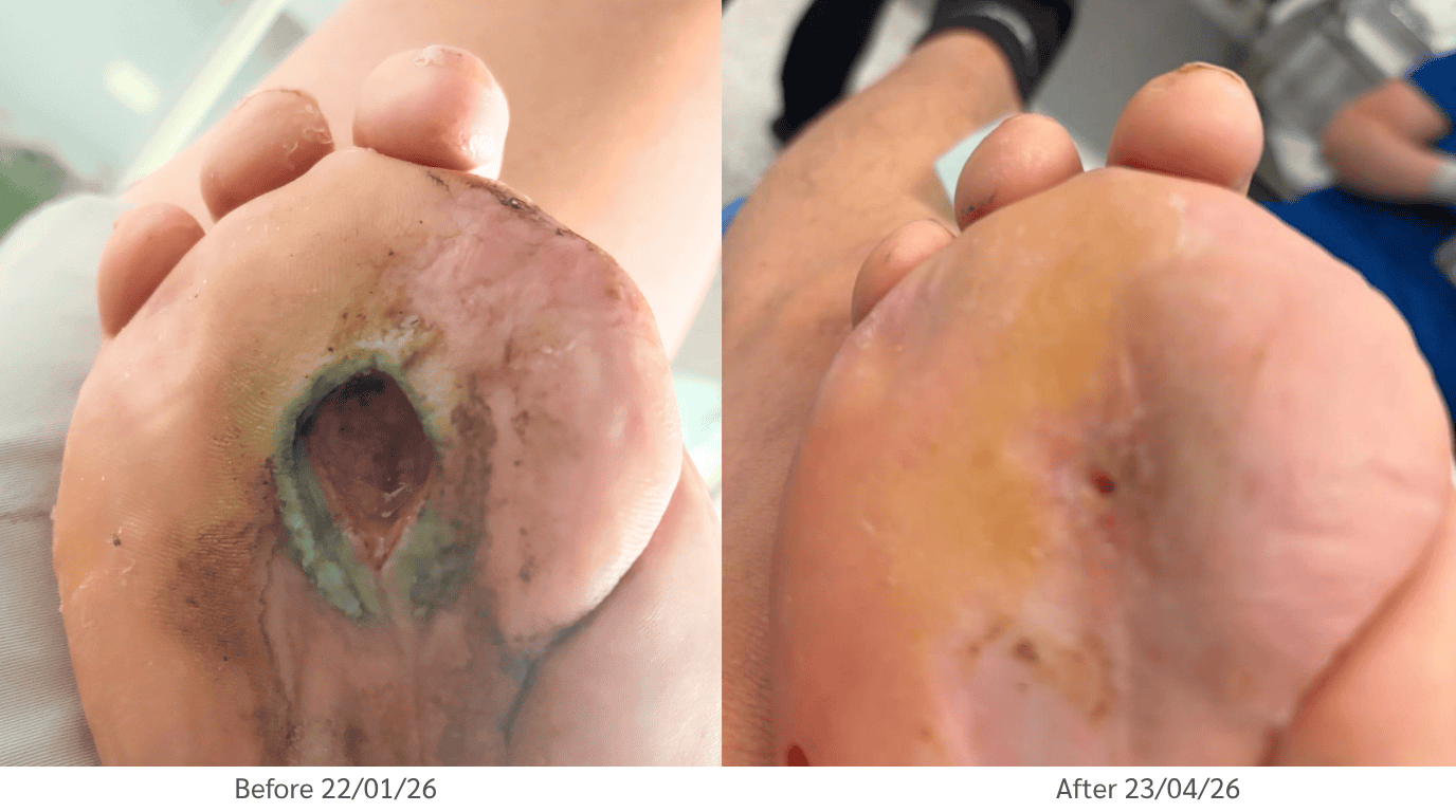 before and after foot ulcer treatment with stem cell therapy at Vega Derma