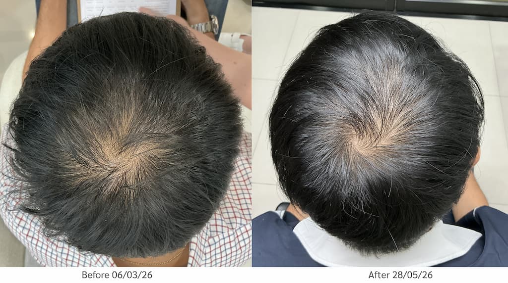 hair restoration with stem cell therapy at Vega Derma