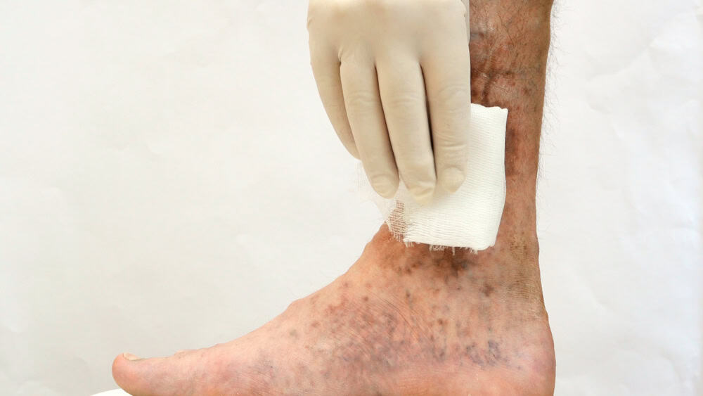 Gauze being applied to the ankle area as part of venous ulcer treatment and supportive therapy.